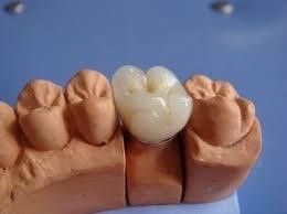Dental Pfm Crown From China Dental Laboratory