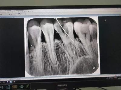 60kv Handheld Dental X-ray Machine Best Dental Equipment