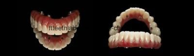 Full Arch Dental Screwed Implant Bridge From China Dental Lab
