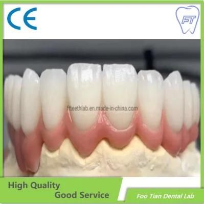 Dental Product Dental Metal Ceramic Crown Made in Foo Tian Dental Lab in Shenzhen China
