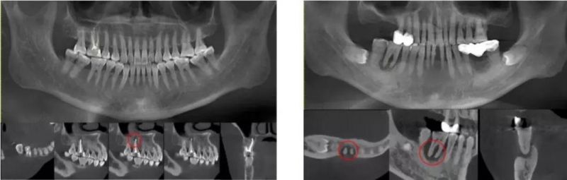 Hires 3D Dental Cbct Implant Inspection Equipment Implant Simulation Tmj Image New Cephalometric Seat Cbct