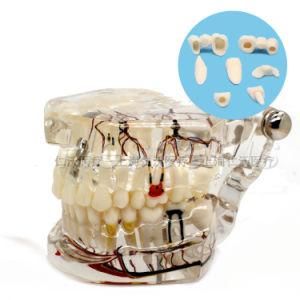 Dental Teeth Implant Model for Teaching