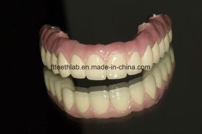 Full Arch Metal Ceramic Implant Supported Bridge