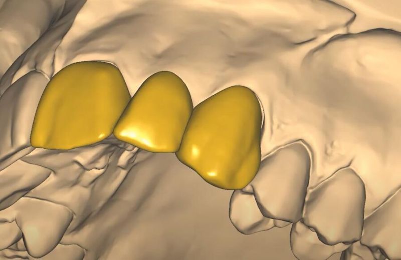 Dental 3shape Exocad Smile Design Service