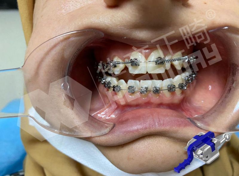Orthodontic Self-Ligating Brackets Dental Roth Brace