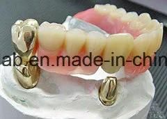 Dental Telescopic Removable Denture Made in China Dental Lab with Very Good Quality and Friction