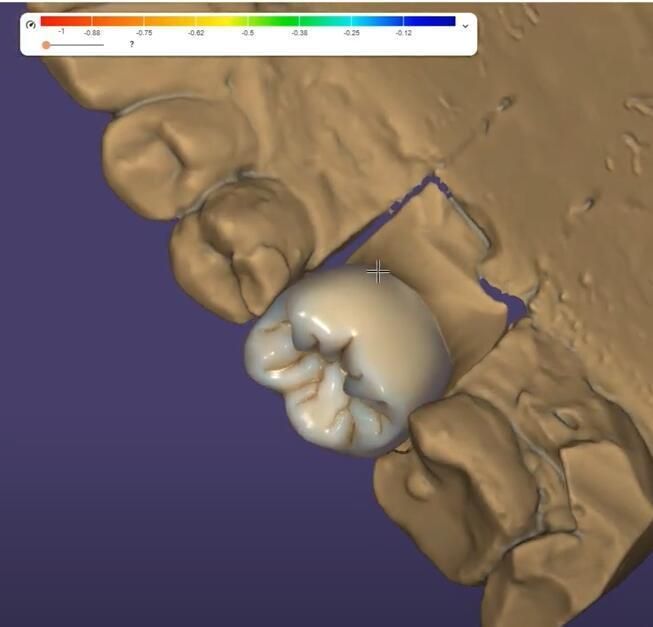 Dental 3shape Exocad Smile Design Service