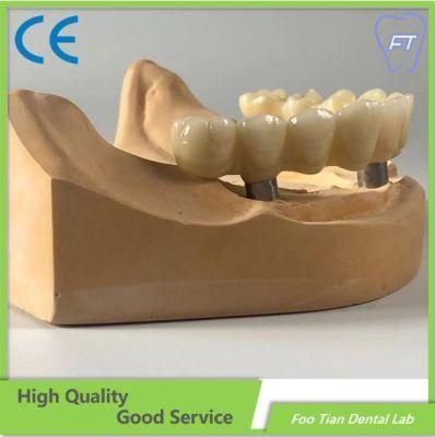 Professional Services Full Arch Metal Ceramic Implant Bridge with Cemented Retained