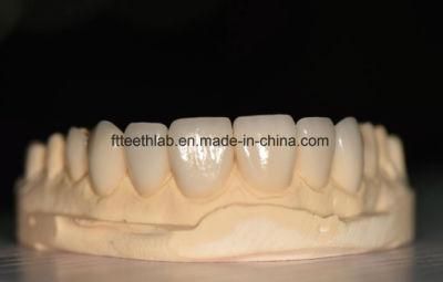 Aesthetic E. Max Veneers with Perfect Fitting