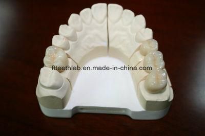 Dental Porcelain Fused to Metal Crown with Natural Looking and Precise Margin