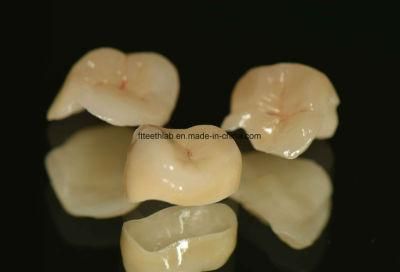 All Ceramic Inlays and Onlays in Dentistry