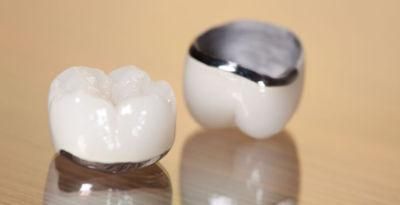 Dental Pfm Crown From China Dental Lab