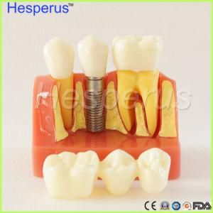 Macro Implant Teeth Model Crown Bridge Demostratation Teeth