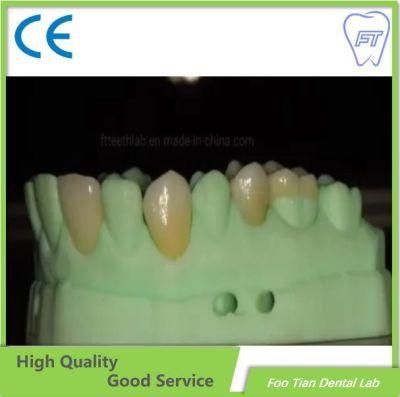 Screwed Metal Ceramic Crown Made with Scan Files Implant Cases From China Dental Lab