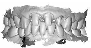 Dental CAD Design Service From China Dental Lab