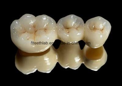 Dental Pfm Bridge From China Dental Lab with Precise Margin and Excellent Fitting and Natural Looking