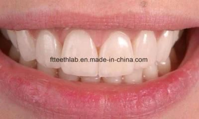 Dental Porcelain Veneers Made in China Dental Lab