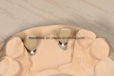 Dental Material Lab Implant Dental Lab Zirconium Custom Implant Abutment Over Ti-Base