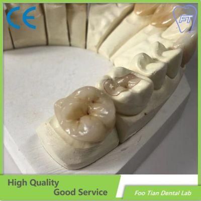 Dental Implant Emax Dental Inlays and Crowns with High Aesthetic