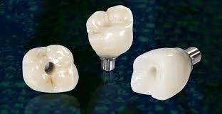 Implant Crown From China Dental Laboratory