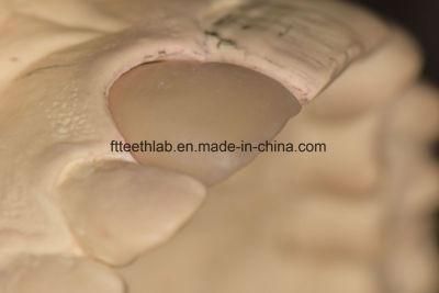 Cosmetic Dental Porcelain Veneers Made in China Dental Lab