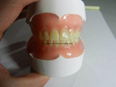 Removable Acrylic Partial Denture