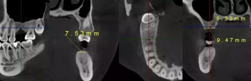 Hires 3D-Plus CE Professional Large Fov Dental 3D Cone Beam Computred Tomography Cbct Equipment