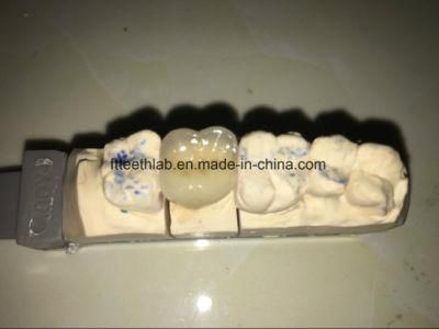 Porcelain Fused Metal Dental Crown Made in China Dental Lab From Shenzhen China