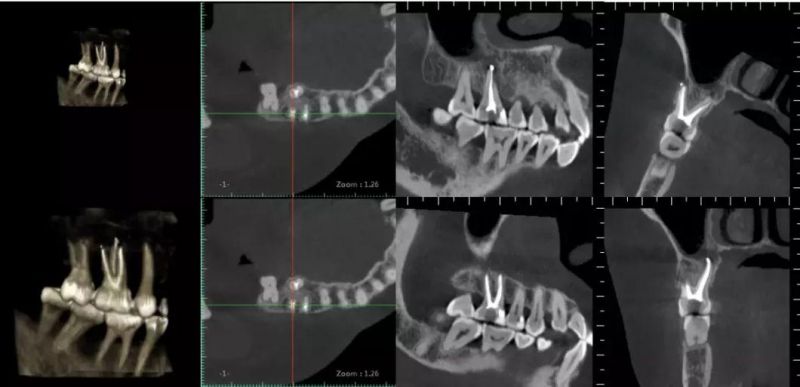 Hires 3D-Plus CE Professional Large Fov Dental 3D Cone Beam Computred Tomography Cbct Equipment