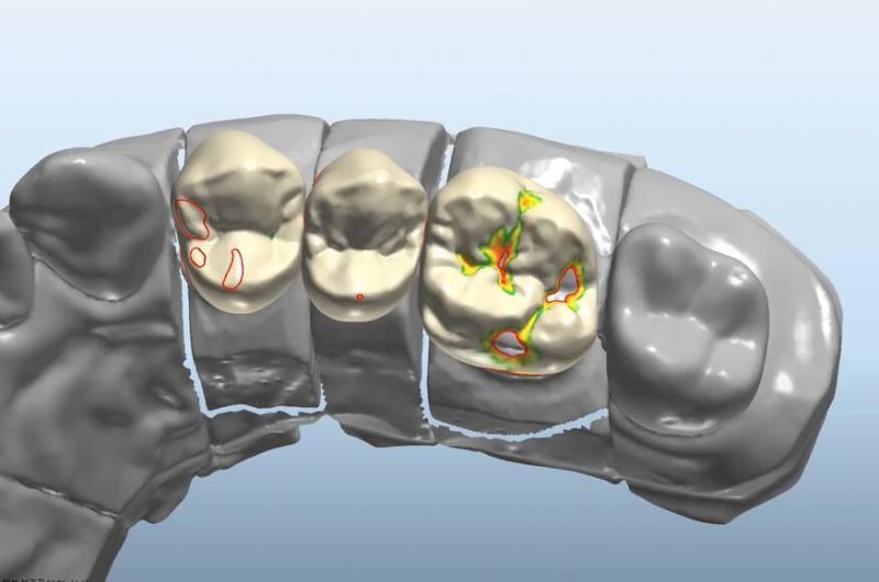 Dental 3shape Exocad Smile Design Service