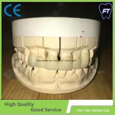 Zirconia Crown and Bridge Implant OEM Bruxzir Solid Stable Zirconia Bridge From China Dental Lab