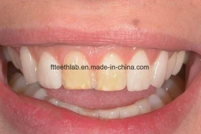 Dental Material Lab Implant Custom IPS Emax Veneers From China Dental Lab