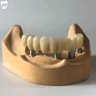 Dental Metal Ceramic Screwed Implant Bridge