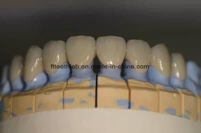 Natural Looking Dental Zirconia Bridge with High Aesthetic