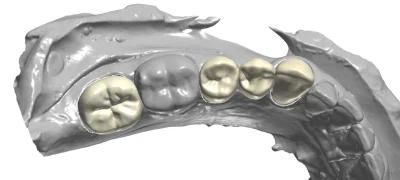 Dental Smile CAD Design