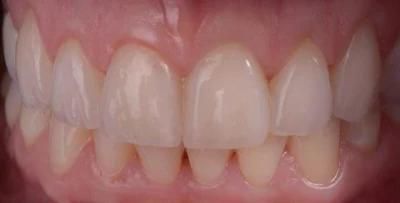 Ultra-Thin Veneers for Hollywood Smile