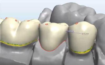 Dental Custom Abutment Full Partial Denture Smile Design Service