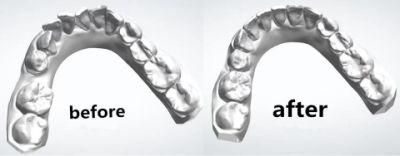 Orthodontic Brace Clear Aligners China Manufacture Dental Lab Delivery Smile Direct to Patients