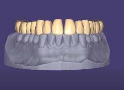 Exocad Smile Design Service From China Dental Lab