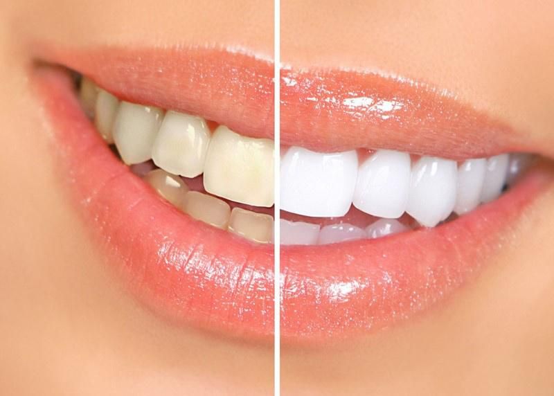 Dental Use Shade Guide for Teeth Whiten Instruction