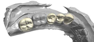 Dental Exocad Smile Design