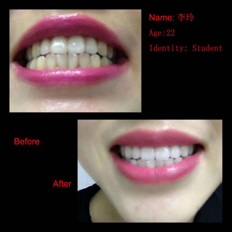 LED Teeth Whitening Kit Private Logo