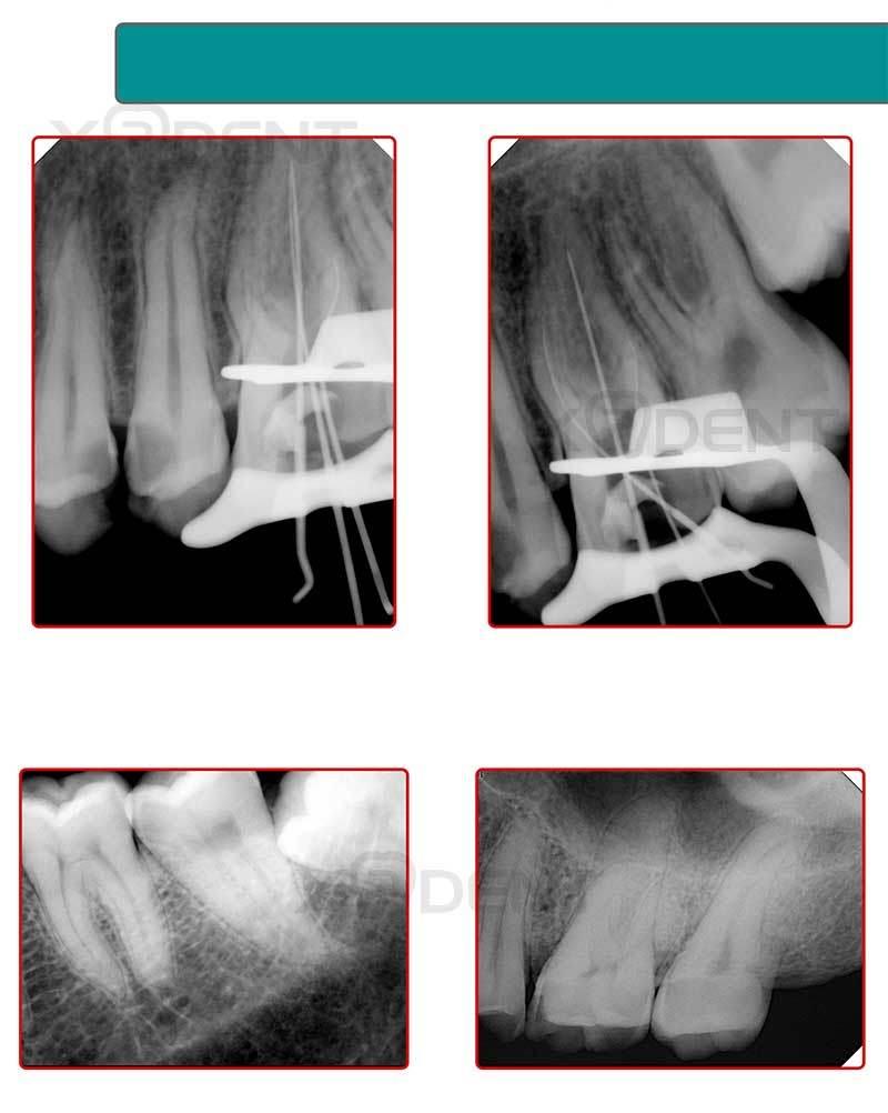 New Pistol-Style 60kv Dental Portable X-ray Machine