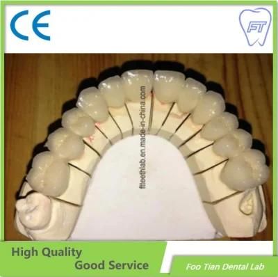 Factory Price Dental Metal Ceramic Crown Made in Foo Tian Dental Lab in Shenzhen China