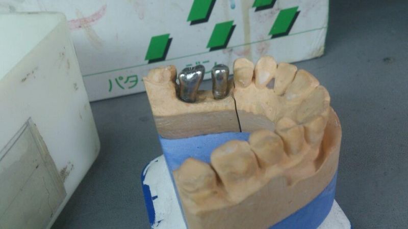Dental Material Lab Implant Dental Custom Abutments Compatible with Nobel, Straumnn, Dentium, Mis, Astra Tech, Zimmer, Dio, Osstem