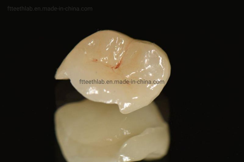 Orthodontic Products Dental Material Supplies Implant Emax Ceramic Inlay/Onlay From China Dental Lab