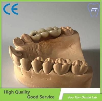 High Quality Full Arch Metal Ceramic Implant Bridge with Cemented Retained