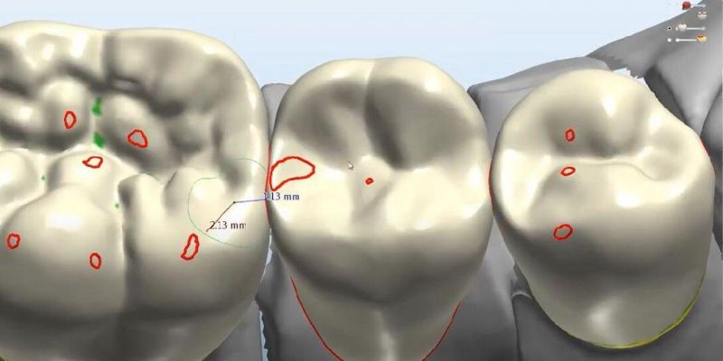 Dental Custom Abutment Full Partial Denture Smile Design Service