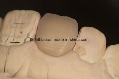 Porcelain Dental Veneers in Cosmetic Dentistry From China Dental Lab