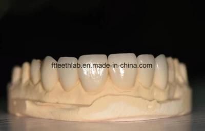 Dental Full Ceramic Veneers From China Dental Lab